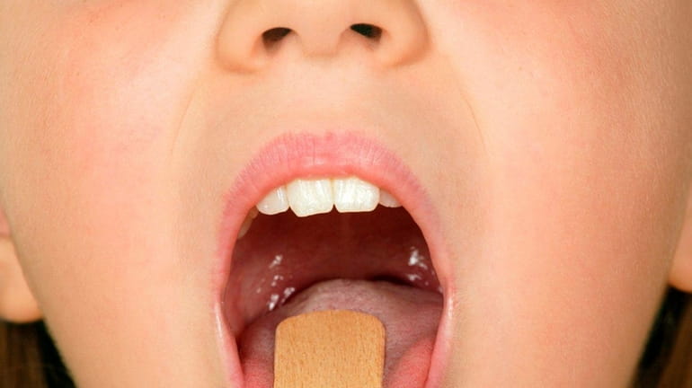 Tonsil stones, or tonsiliths, are formed by food particles that...