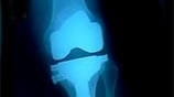 Joint replacement might boost physical activity in arthritis patients, study...