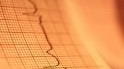 While U.S. hospital admissions for atrial fibrillation were up, death...
