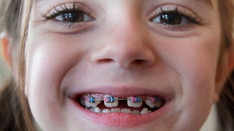Madison Petrusa, 7, of Commack, shows off her braces at...