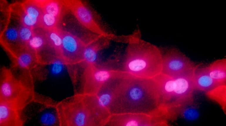 A culture of human breast cancer cells, in an undated...