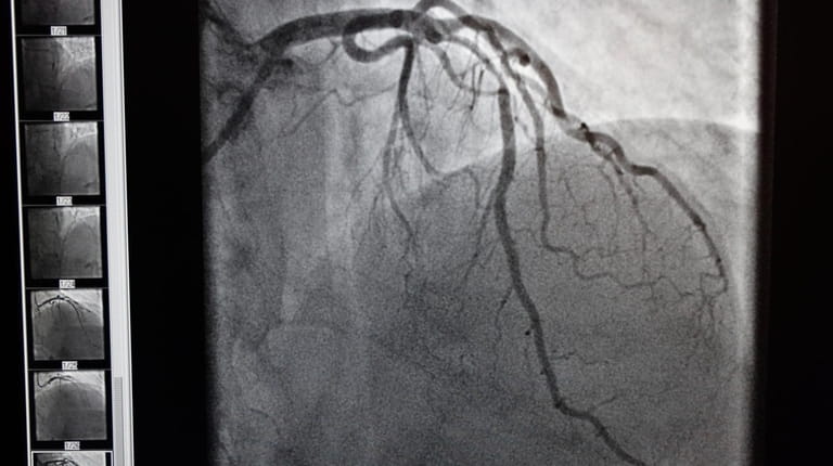 A high contrast image of the left coronary article of...
