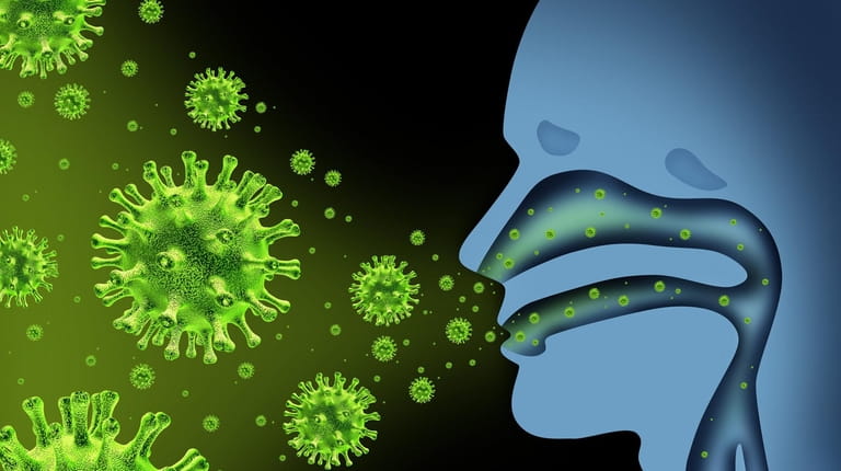 Flu virus spread caused by influenza with human symptoms of...