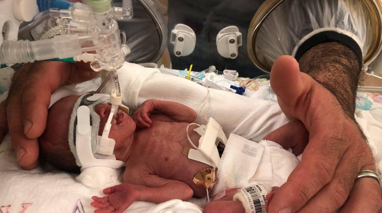 Dawsyn Harper Holmes, was born 15 weeks premature on Feb....