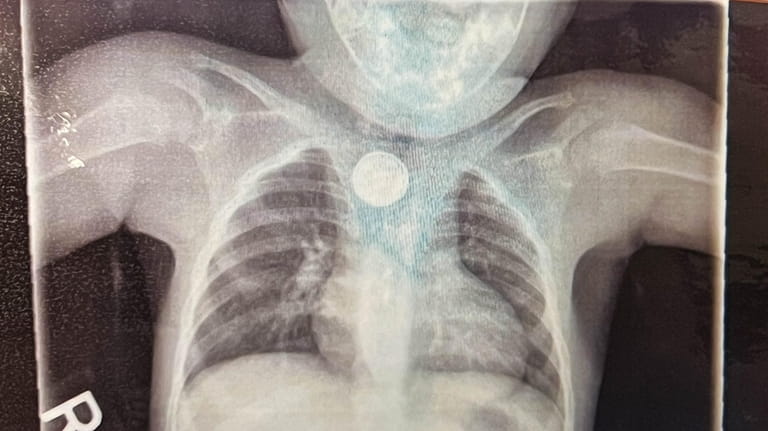 A button battery is visible on an X-ray. 