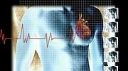 Rare genetic variation appears to cut the risk of heart...